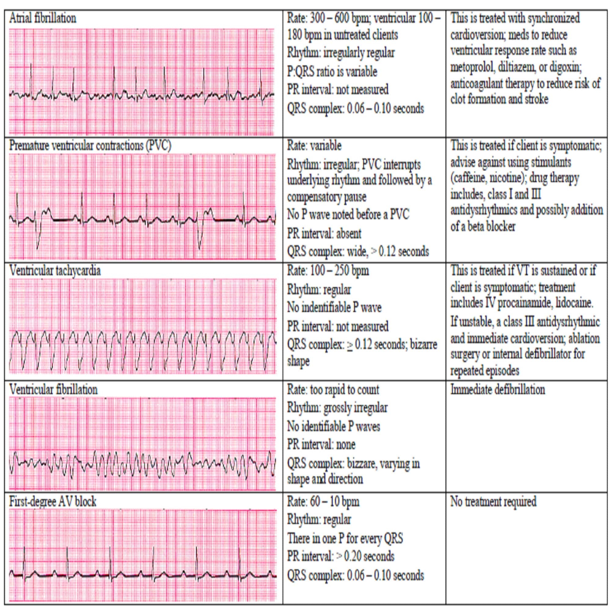 13 Cardiac Rhythm And Dysrhythmias Cheat Sheet Any Nurse Must Know For The Exam Etsy